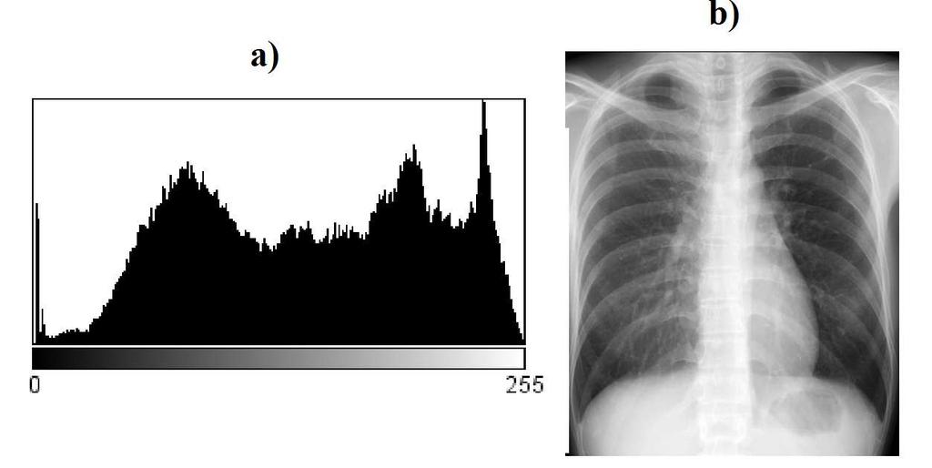 3. RESULTADOS Depois de obtidas as imagens com o simulador de corpo estas foram analisadas com auxílio do programa ImageJ e comparadas inicialmente com cinco imagens reais de radiografias do tórax.