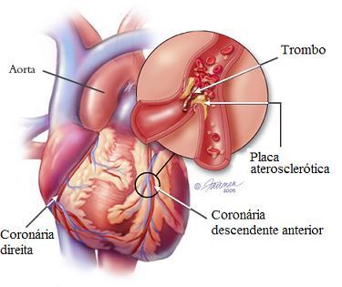 3 SISTEMA CIRCULATÓRIO Afecções do Sistema Cardiovascular Aterosclerose Coronariana Conceito: Acúmulo anormal de substância