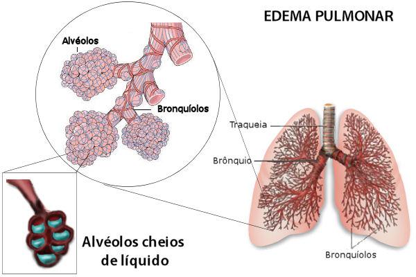 Edema Agudo de Pulmão (EAP) Conceito: Edema pulmonar é o acúmulo anormal de líquidos nos pulmões.