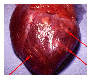 Sinais e Sintomas: São decorrentes das lesões das válvulas cardíacas e da toxidade da infecção.