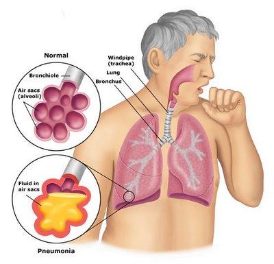 A pneumonia pode ainda ocorrer, como complicação, após algumas doenças transmissíveis como o sarampo, coqueluche, escarlatina.