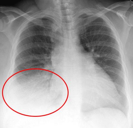 Também pode ocorrer pneumonia por inalação de gases irritantes.