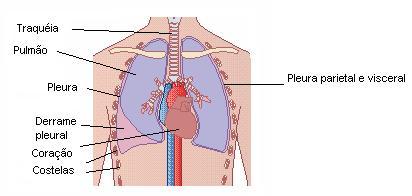 Complicações: Hipotensão e choque, especialmente em pacientes que não receberam tratamento adequado; Atelectasia, colapso pulmonar, devido à obstrução dos brônquios pelas secreções acumuladas;