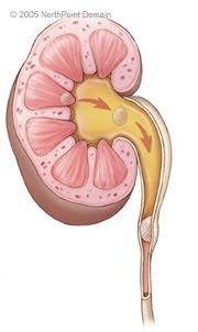 relação); Uso de diafragma-espermicida; Ingestão de líquido insuficiente e longo período sem urinar. Incidência: É mais frequente em mulheres, causada principalmente por Escherichia coli.