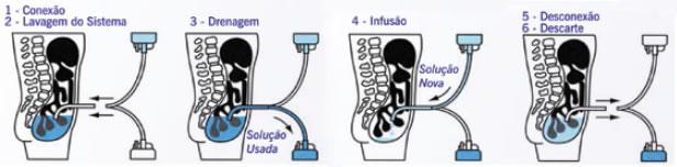 Para os pacientes com IRC, a diálise é o único meio de manter a vida, caso o transplante renal não tenha sucesso ou não seja possível.