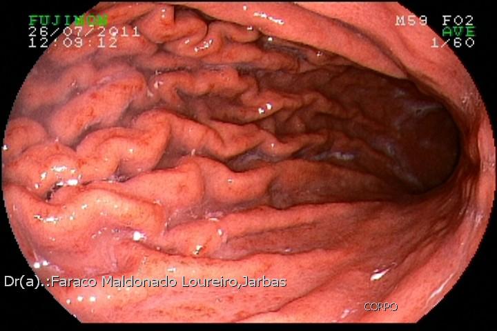 caso. Gastrite Conceito: Inflamação aguda ou crônica da mucosa gástrica.