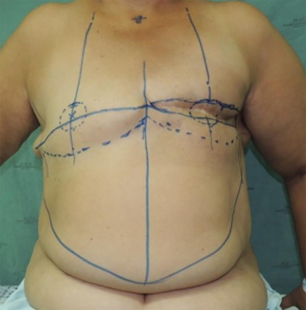 Reconstrução de mama com miniabdominoplastia reversa Figura 4. O retalho é incisado na linha média, bipartindo-o em dois retalhos triangulares de base inferior. Figura 2.