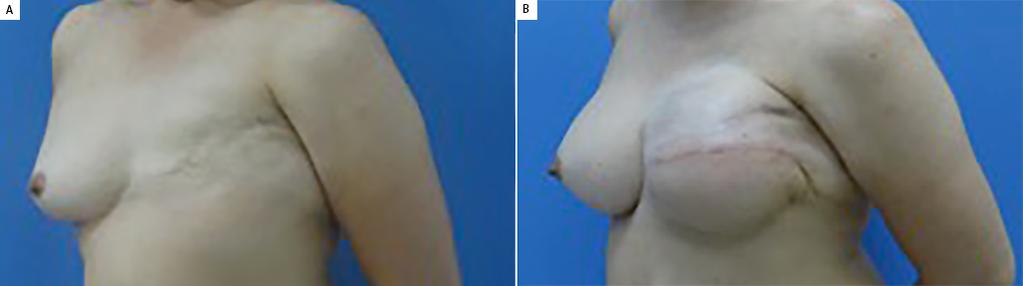 A B Figura 12. A: Pré e pós-operatório - posição de frente; B: Pré e pós-operatório - posição de frente. A B Figura 13.