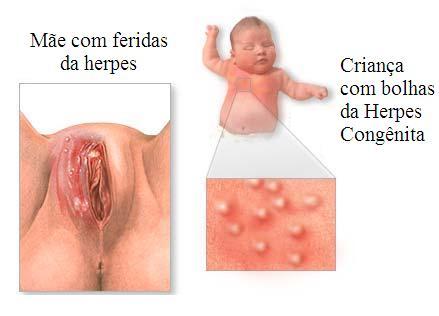 Observação Na Herpes Congênita, o vírus é