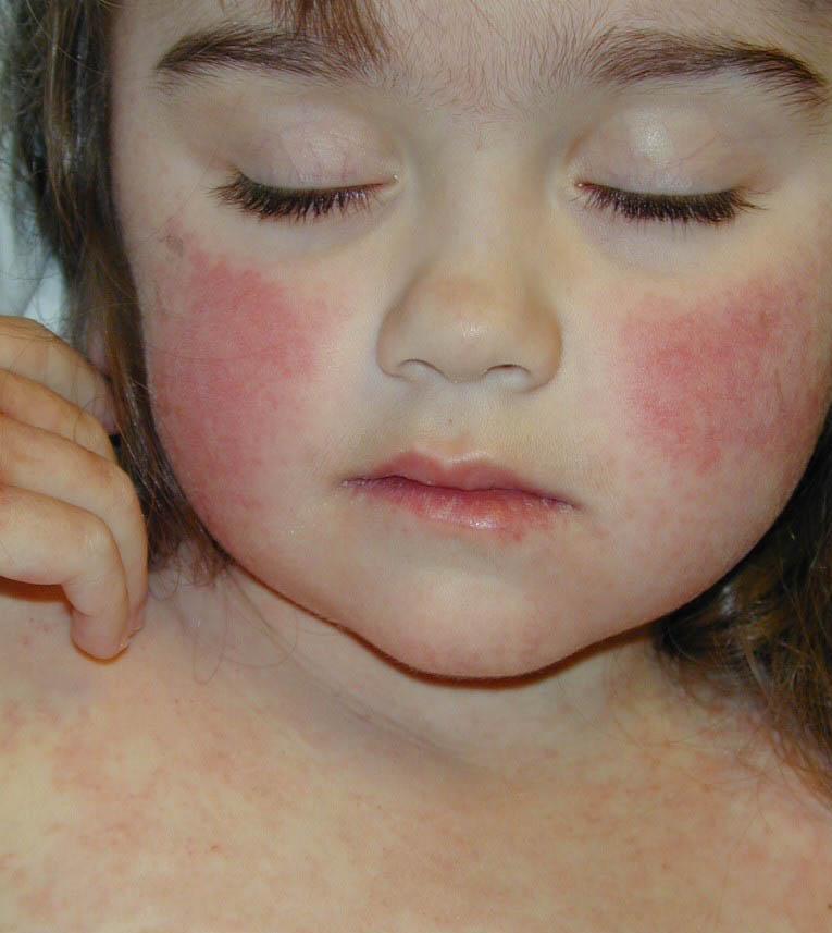 Agente: Parvovírus (B19). Parvovirose Humana (Eritema infeccioso) Transmissão:Secreções respiratórias ou de mãe para filho na gestação.