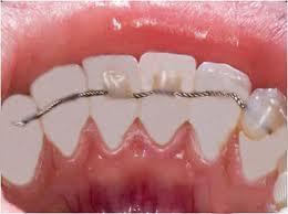 dentes após tratamento