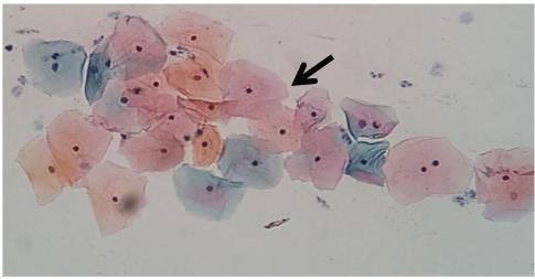 1.1.5 O Colo uterino e a junção escamo- colunar O colo do útero ou ectocérvice é composto de epitélio escamoso não queratinizado, esse epitélio é formado por células superficiais (Fig.