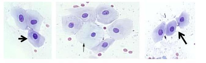 Figura 2- Células escamosas intermediárias, originadas da ectocérvice, coloração de Papanicolaou, (100x). Fonte: http://www.vivo.colostate.edu, acesso em 08/12/2016. Células basais e parabasais (Fig.