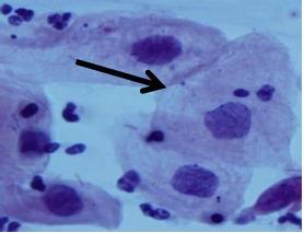 Figura 6- Célula escamosa intermediária normal, originadas da ectocérvice, coloração de Papanicolaou, (400x). Fonte: www.ebah.com.