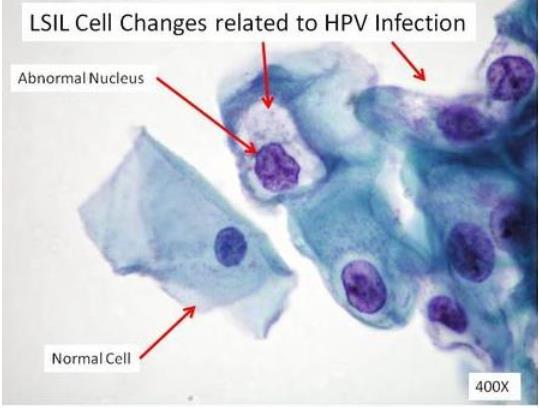 1.2.3 LSIL Lesão intra-epitelial escamosa de baixo grau (Fig. 10), compreende o efeito citopático pelo HPV.