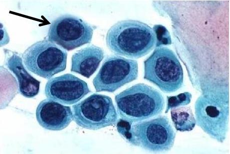1.2.4 HSIL A lesão intra-epitelial escamosa de alto grau (Fig. 11) ocorre em células mais profundas, células imaturas como nas parabasais (Fig.8).