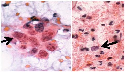 1.2.6 Carcinoma Epidermóide Invasor É o neoplasma maligno mais comum da cérvice uterina, apresenta fundo do esfregaço necrótico, figuras celulares bizarras,