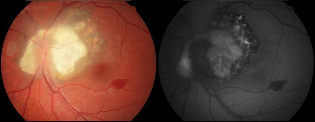 Silva RP, Alencar LD, Moreira-Neto CA Figura 6. A retinografia e a autofluorescência do fundo mostraram o tumor após fotocoagulação com laser amarelo na margem temporal.