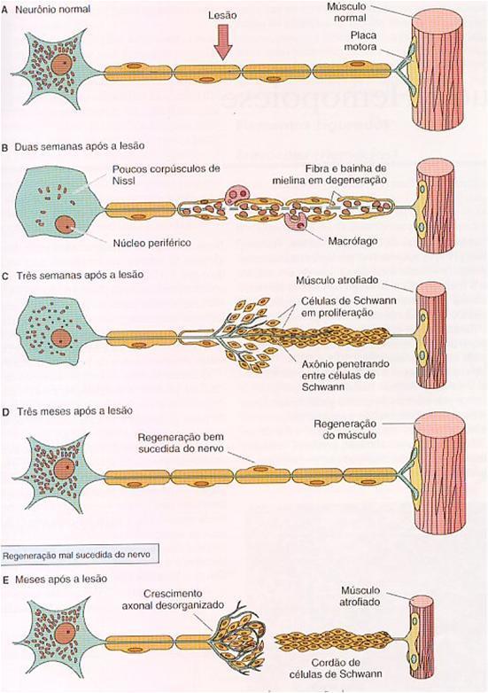Regeneração de fibras nervosas Neurônios danificados no axônio tem a possibilidade de regenerar esta região Região do axônio separada do corpo celular se degenera e é fagocitada por