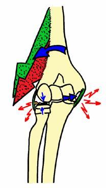 A fixação desta lesão é consequência do espasmo dos músculos radiais e braquiorradial.