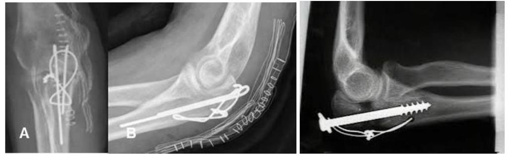 Complicações secundárias: Infecção; Síndrome de Volckman; Deslizamento secundário, devido ao tríceps. Complicações tardias: Calo vicioso, que provoca uma artrose de cotovelo; Rigidez.