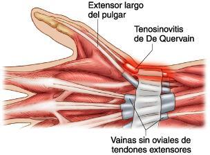 SINTOMATOLOGIA: Dor a face dorsal da mão com inchaço. Dor que aumenta com a contração isométrica de: Extensão dos dedos (extensor comum). Extensão do punho em inclinação radial (radiais).