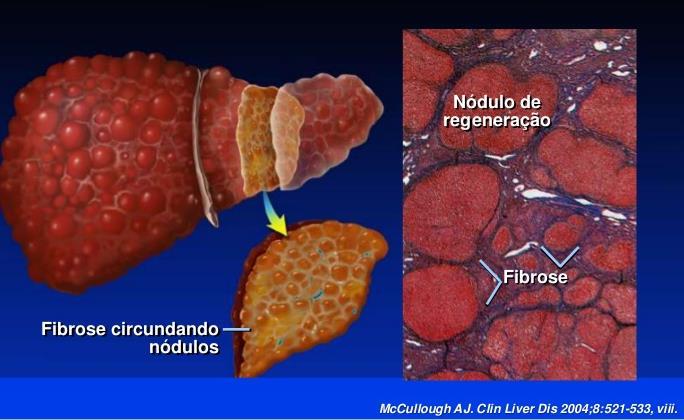 Sistema Digestivo - fígado Usualmente o tecido hepático regenerado é igual ao preexistente.