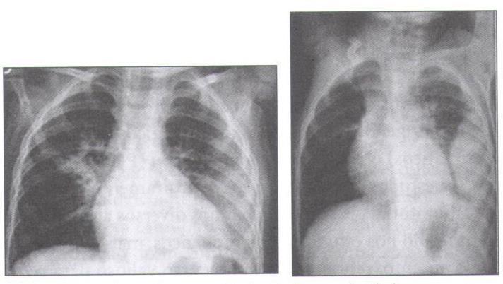 Diagnóstico radiológico: Apagamento de seios