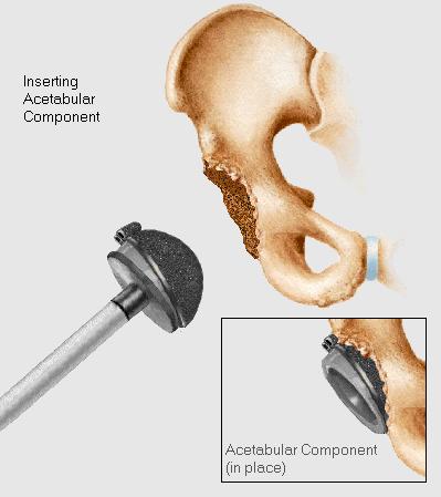 artroplastia total da anca processo cirúrgico