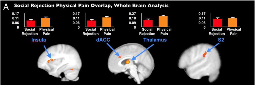Fig. 2. Neural overlap between social rejection and physical pain.