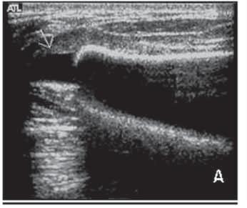 Figura 10 - Ultra-sonografia de mama com implante de silicone, demonstrando pequeno conteúdo de líquido adjacente ao seu contorno