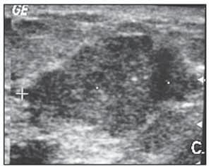 isoladas no parênquima fibroglandular e (C)