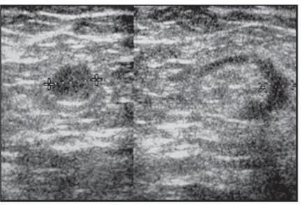Figura 20 - Padrões ultra-sonográficos do linfonodos axilares.