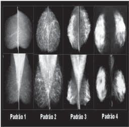 Padrão 1 mamas predominantemente lipossubstituídas (menos de 25% de densidades de tecido fibroglandular), nas quais a mamografia tem alta sensibilidade.