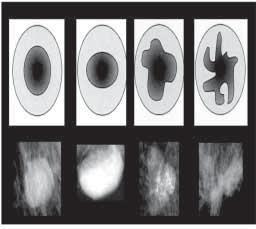 A) MORFOLOGIA - a forma do nódulo deve ser descrita seguindo a terminologia: a) redonda esférica ou circular b) oval elíptica ou em forma de ovo c) lobular com aspecto ondulado d) irregular quando