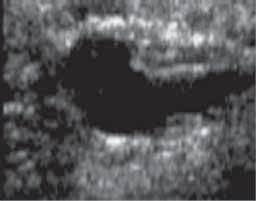 LINFONODOS INTRAMAMÁRIOS Geralmente são nódulos ovóides, circunscritos, com centro radiotransparente correspondendo ao hilo adiposo e menores de 1,0 cm, geralmente nas
