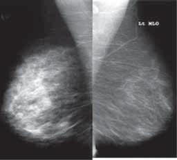 ses casos, não se observam nódulos, microcalcificações suspeitas ou distorção de arquitetura associados. Em geral é uma variante antômica normal mas pode ter significado patológico, se palpável. 4.