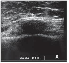 predominantemente adiposa, com ilhotas gordurosas hipoecogênicas delimitadas pelos já referidos ligamentos de Cooper.