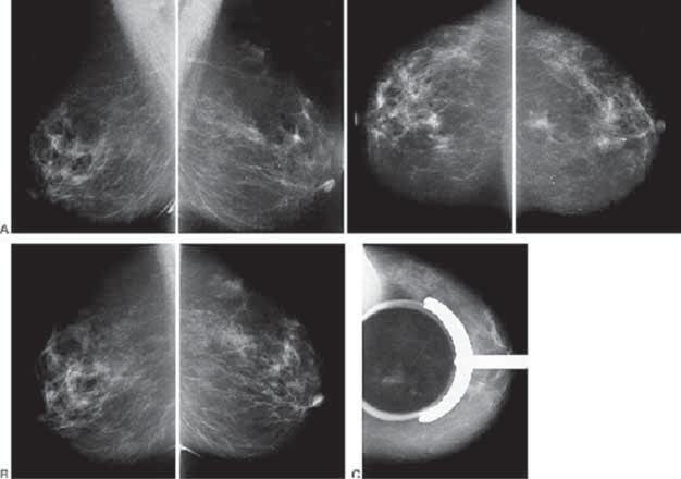 Figura 5 - de rastreamento evidenciando área de assimetria focal na interseccção dos quadrantes superiores da mama esquerda.