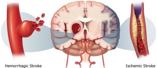 INTRODUÇÃO AVC é um síndrome causado por interrupção de fluxo sanguíneo a parte do cérebro devido à oclusão de vaso sanguíneo (isquémico 80% dos casos) ou por ruptura de vaso