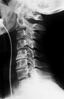 ATLS Objetivo das radiografias: Checar posição de tubos. Identificar pneumotorax. Posição do mediastino. Diafragma.