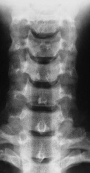 fratura O alinhamento vertebral Altura dos