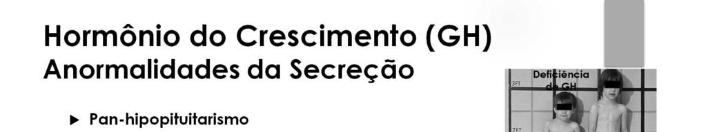 A maioria dos casos de nanismo resulta de deficiência generalizada da secreção adeno-hipofisária (pan-hipopituitarismo) durante a infância.