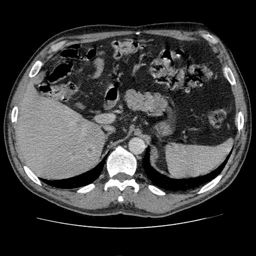 supra-renal esquerda suspeita de