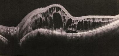 Escaneamento tomográfico antes do início do tratamento. Observa-se degeneração cística da retina.