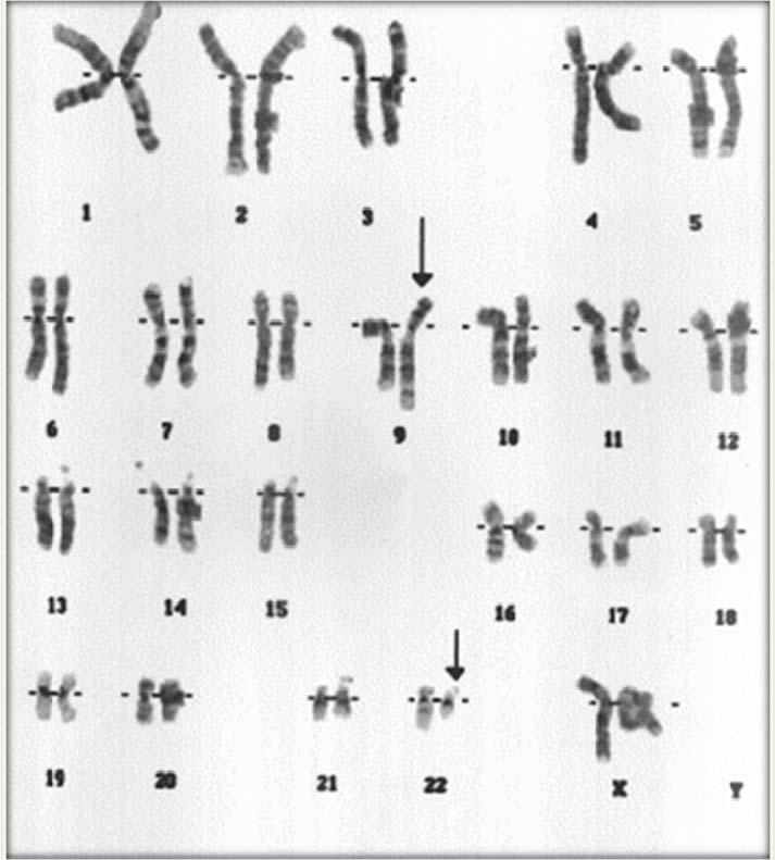18 Depois da ocorrência da translocação, o novo cromossomo 9 aumenta de tamanho em função do ganho de material genético, enquanto o novo 22 apresenta tamanho encurtado, facilmente visualizado no