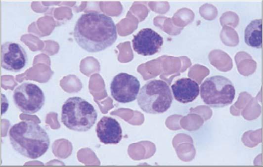 A figura 7 indica a composição alterada do sangue periférico com aumento dos eosinófilos e basófilos, além da presença de células imaturas da linhagem granulocítica.