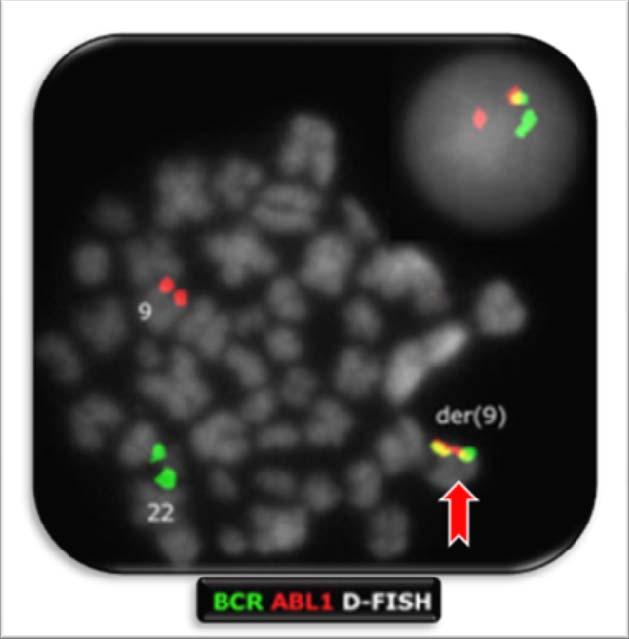 25 Figura 9 Hibridização in situ fluorescente (FISH). Fonte: BIXBY; TALPAZ, 2009. Nota: O BCR no cromossomo 22 está marcado em verde. O ABL no cromossomo 9 é assinalado em vermelho.