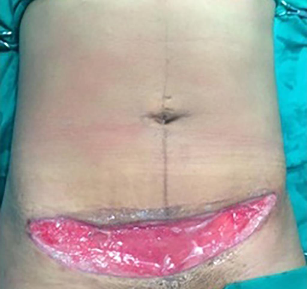 Reconstrução de parede abdominal ABSTRACT Introduction: Patients with abdominal wall defects present challenging complications that require the use of advanced surgical approaches.