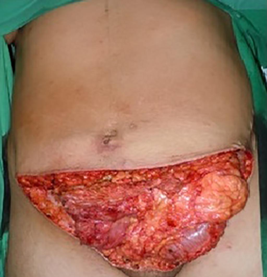 Kawamura K et al. www.rbcp.org.br Figura 4. Defeito decorrente da exérese de sarcoma de parede abdominal. Figura 2. necrosante com acometimento de espessura total da parede abdominal.